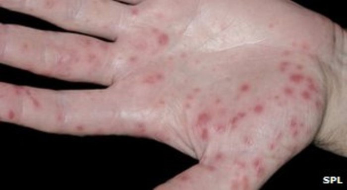 hand-foot-and-mouth disease