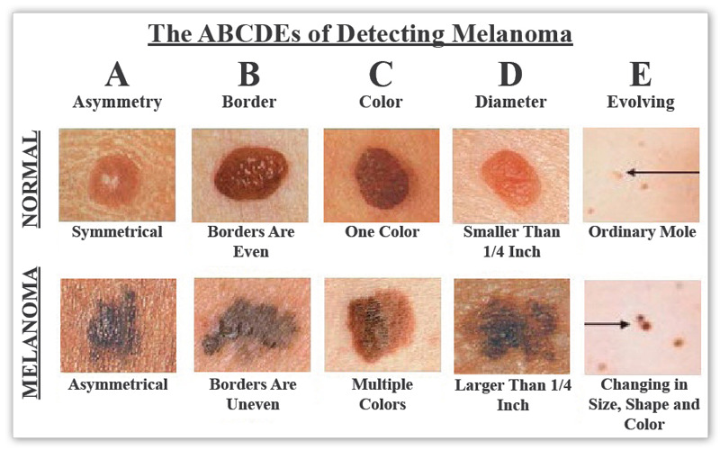 ABCDEs of Skin cancer
